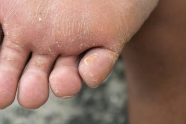 Kurumuş ve ölü ayakların derisini yüzün.