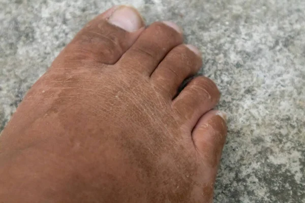 乾燥し死んだ足の皮膚の終わり足の剥離 — ストック写真