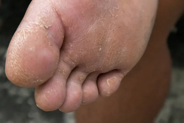 乾燥し死んだ足の皮膚の終わり足の剥離 — ストック写真