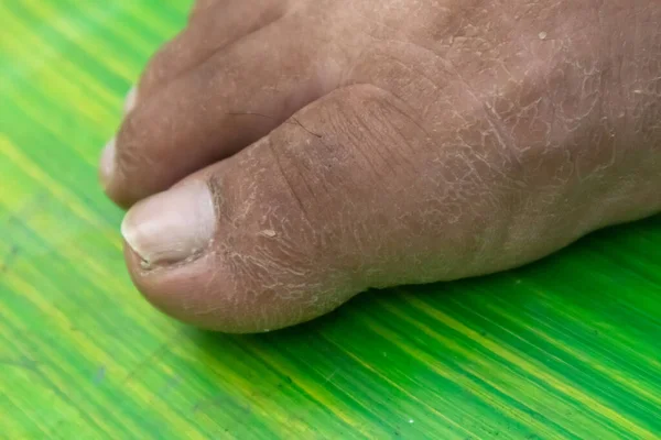 Primo Piano Pelle Piedi Secca Morta Peeling Piede — Foto Stock