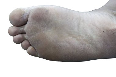 Kurumuş ve ölü ayakların derisini yüzün.