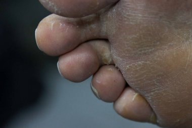 Kurumuş ve ölü ayakların derisini yüzün.