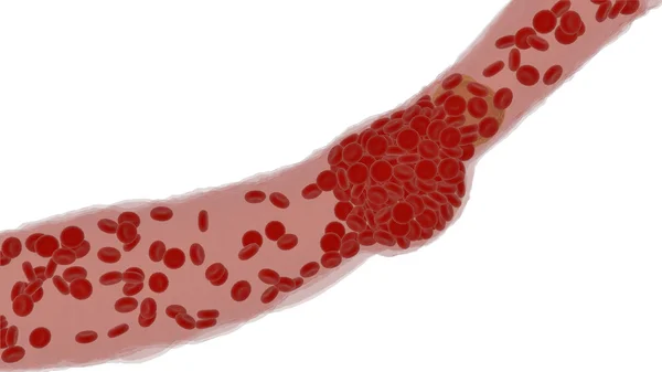 Clogged Artery with platelets and cholesterol plaque, concept for health risk for obesity — Stock Photo, Image