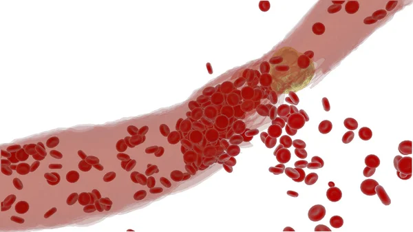 Arteria con plaquetas y placa de colesterol, concepto de riesgo para la salud de la obesidad — Foto de Stock