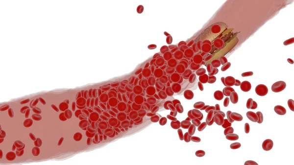 Clogged Artery with platelets and cholesterol plaque, concept for health risk for obesity — Stock Photo, Image