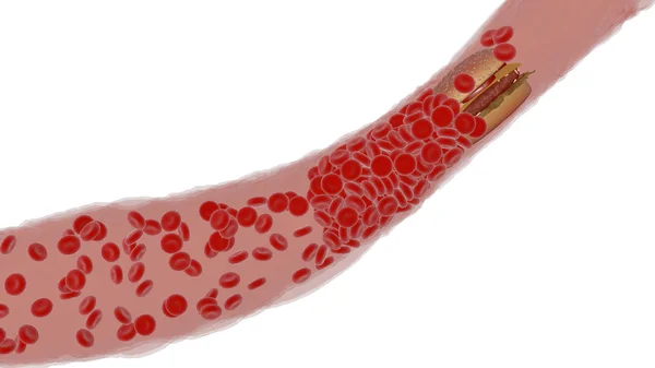 Arteria ostruita con piastrine e placca di colesterolo, concetto per il rischio di salute per l'obesità — Foto Stock