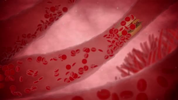 Verstopfte Arterie mit Blutplättchen und Cholesterinplaque, Konzept für Gesundheitsrisiken bei Fettleibigkeit oder Diät- und Ernährungsproblemen — Stockvideo