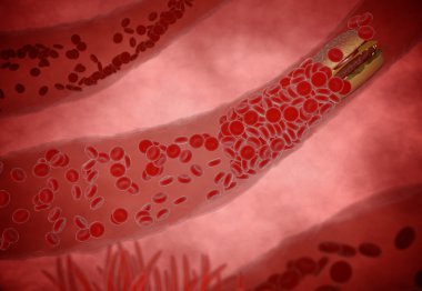 kolesterol arter engellenmiş, tıp kavram insan kan damarı ile sağlıksız beslenme yağ gıda hamburger tıkanmış ve kızarmış gıdalar, diyet ve beslenme sorunları veya obezite için bir sağlık riski olarak