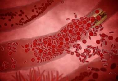 Tıkanmış arter kolesterol plak, kavram 3d animasyon