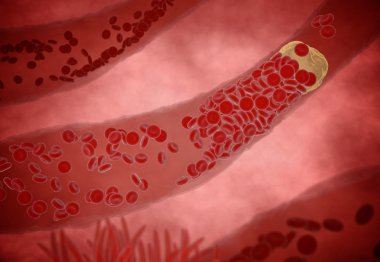 Clogged Artery  cholesterol plaque, concept 3d animation clipart
