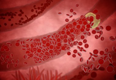Tıkanmış arter kolesterol plak, kavram 3d animasyon