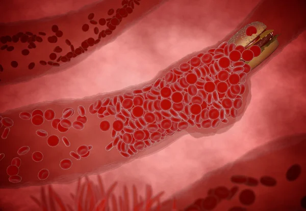 Colesterol bloqueado artéria, conceito médico com um vaso sanguíneo humano entupido por alimentos gordurosos não saudáveis como hambúrgueres e frituras, como um risco para a saúde da obesidade ou problemas de dieta e nutrição — Fotografia de Stock