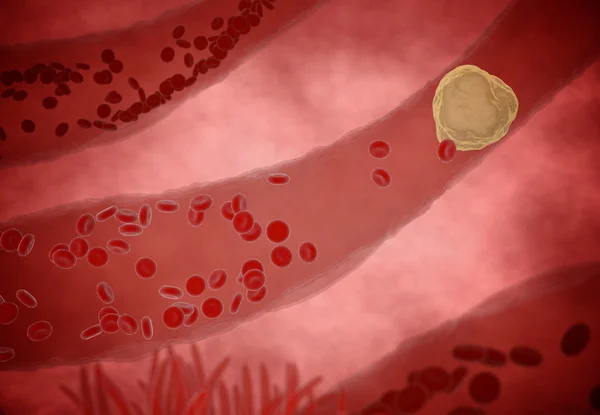 Забитий наліт холестерину артерії, концепція 3d анімації — стокове фото