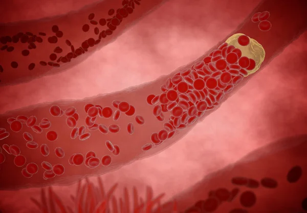 Clogged Artery  cholesterol plaque, concept 3d animation — Stock Photo, Image