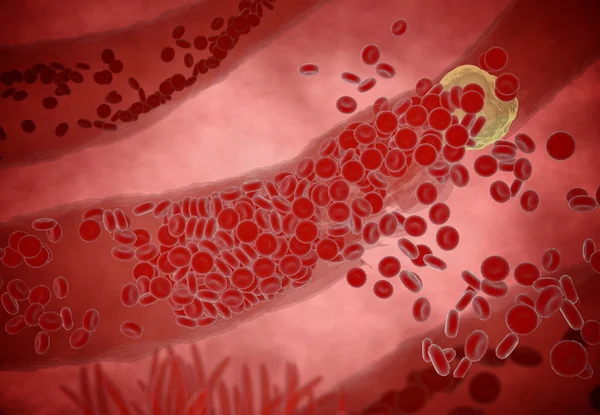 Clogged Artery  cholesterol plaque, concept 3d animation — Stock Photo, Image