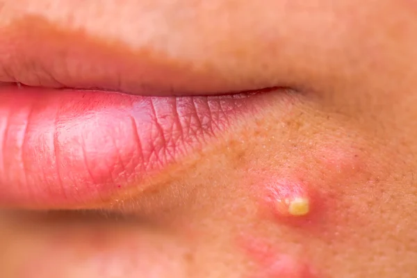 Spot on face under lips due to acne.