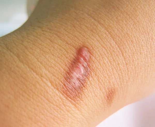 Cicatriz en la piel humana — Foto de Stock