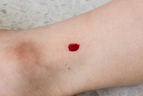 Sangrado de la herida — Foto de Stock