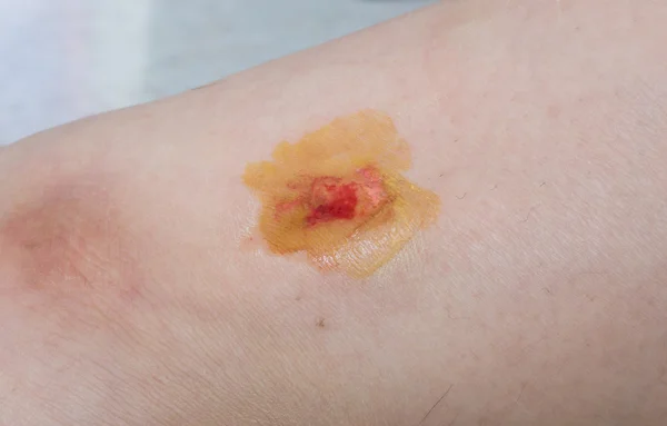 Herida en pierna de mujer — Foto de Stock