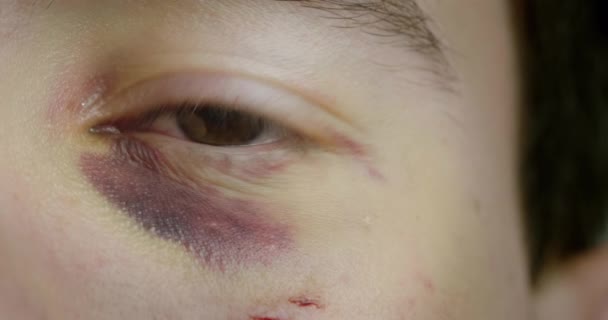 O olho de um homem com hematomas e escoriações — Vídeo de Stock