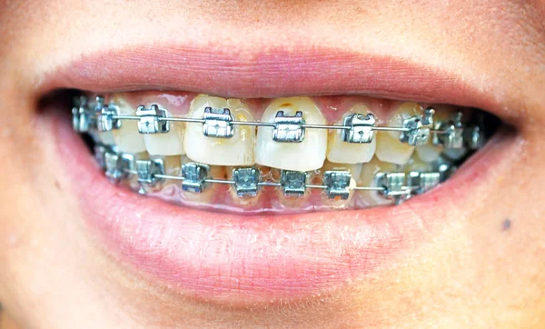 Bilden av tandställning — Stockfoto