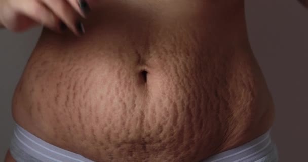 Břicho kůže s těžkými striemi vrásek — Stock video
