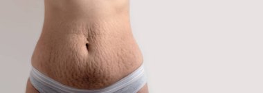 skin stretch marks on female belly clipart