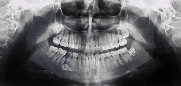 Immagine Panoramica Bianco Nero Radiografia Dentale Adulti — Foto Stock