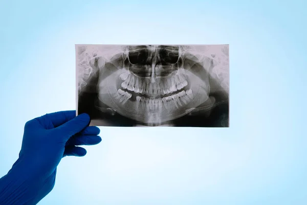 Rukavici Drží Snímek Pacientova Zubu Přes Modré Pozadí Lékař Analyzuje — Stock fotografie