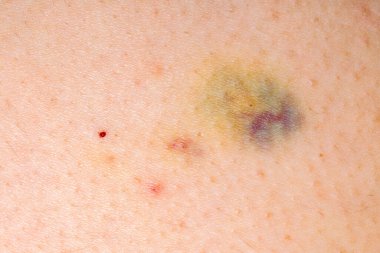 Görünür bir çürük, küçük yaralar ve gözenekli makro insan derisi. Tıbbi, sağlık hizmetleri veya yaralanmayla ilgili kavramlar için ideal.