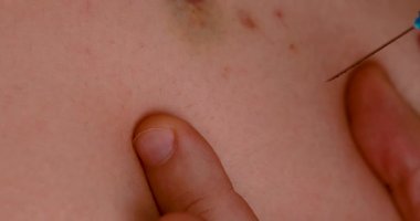 Enjeksiyon yapılan bir elin yakın çekimi, tıbbi bakım ve aşı konseptini gösteriyor.