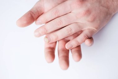 Tırnaklarda mantar enfeksiyonu, onikomikozlu parmak, insan elinde hasar..