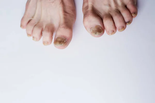 Fungo Prego Doença Pernas Infecção Fúngica Nas Pernas Das Unhas — Fotografia de Stock