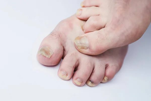 Fungo Prego Doença Pernas Infecção Fúngica Nas Pernas Das Unhas — Fotografia de Stock