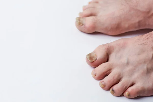 Fungo Prego Doença Pernas Infecção Fúngica Nas Pernas Das Unhas — Fotografia de Stock