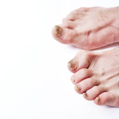 Ayak hastalığında mantar. Tırnaklarında mantar enfeksiyonu olan pankart, onikomikozlu parmak, insan bacağında hasar..