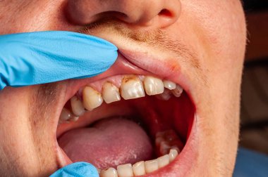 Adamın ağzı açık, acil dikkat gerektiren bir diş sorununu ortaya çıkarıyor.