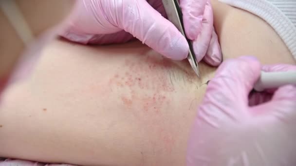 Remoção de procedimento de cabelo permanentemente em axilas de mulheres usando eletro epilation — Vídeo de Stock