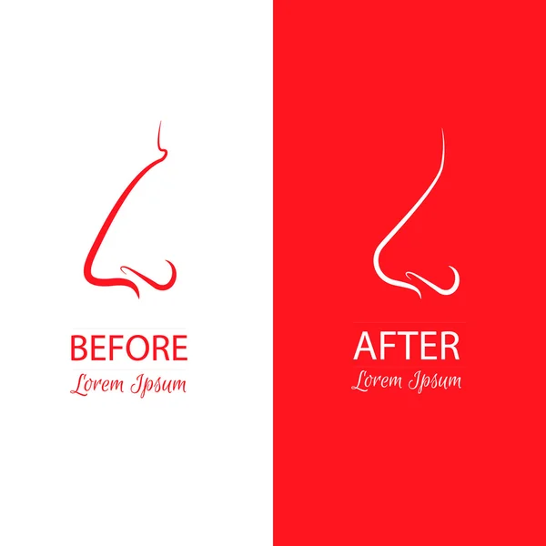 Nose reshaping before and after surgery