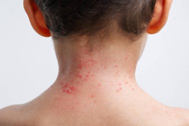 Çocuk derisinde suçiçeği lekeleri var. Erkek boynunda Coxsackie virüsü