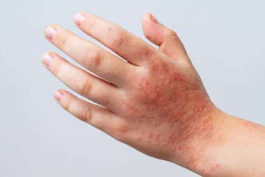 Coxsackie virüsünün kızarıklıkları yakın planda. Suçiçeği ve alerji semptomları beyaz arka plandaki çocuk vücudunda.