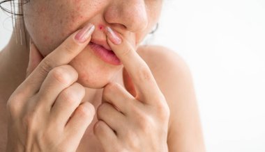 Sivilceli ve sivilceli kadın yüzü portresi. Genç bir kız, yüz derisinde iltihaplı kırmızı sivilceler çıkarır. Beyaz arka planda parmaklarını yakın plan çeker.