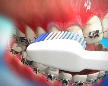 Diş Temizleme işlemi