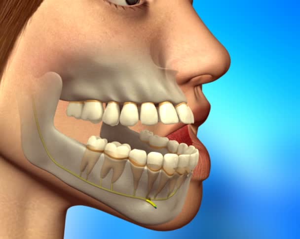 Cirurgia ortognática na mandíbula — Vídeo de Stock