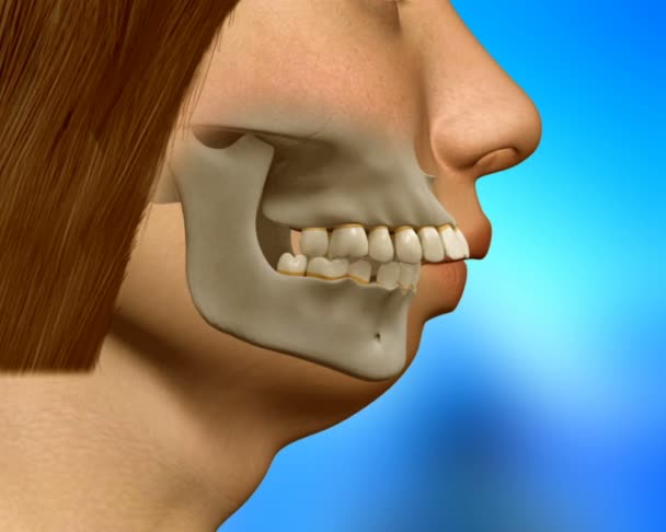 Orthognathic surgery on jaw — Stock Video