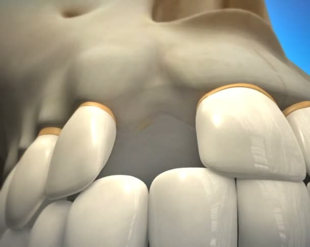 Installatieproces van dental implant — Stockvideo