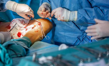 Hastanede, ameliyathanede varisli damar ameliyatı.