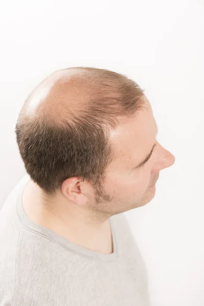 Calvície Alopecia homem queda de cabelo cuidado do cabelo — Fotografia de Stock