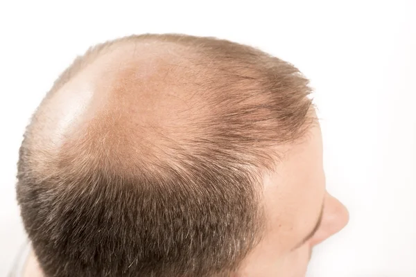 Kaalheid Alopecia man haar verlies haarverzorging — Stockfoto