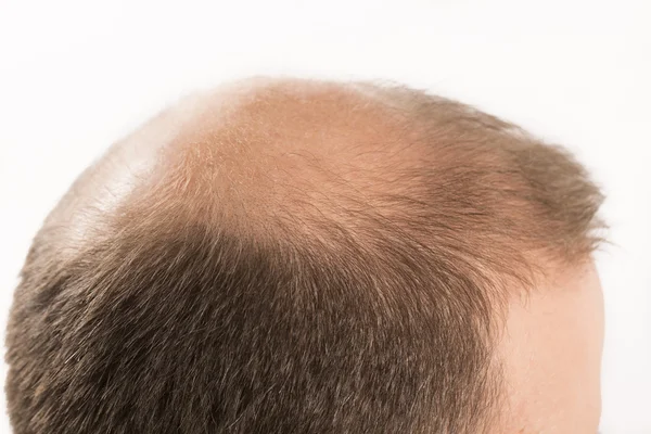 Calvície Alopecia homem queda de cabelo cuidado do cabelo — Fotografia de Stock